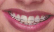 Ceramic Clear