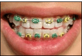 Metal Self Ligating Braces