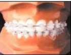 Invisible Braces(aligners)