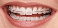 Ceramic Self Ligating  Braces