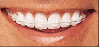 Ceramic Poly Crystalline Braces