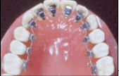 Lingual Braces